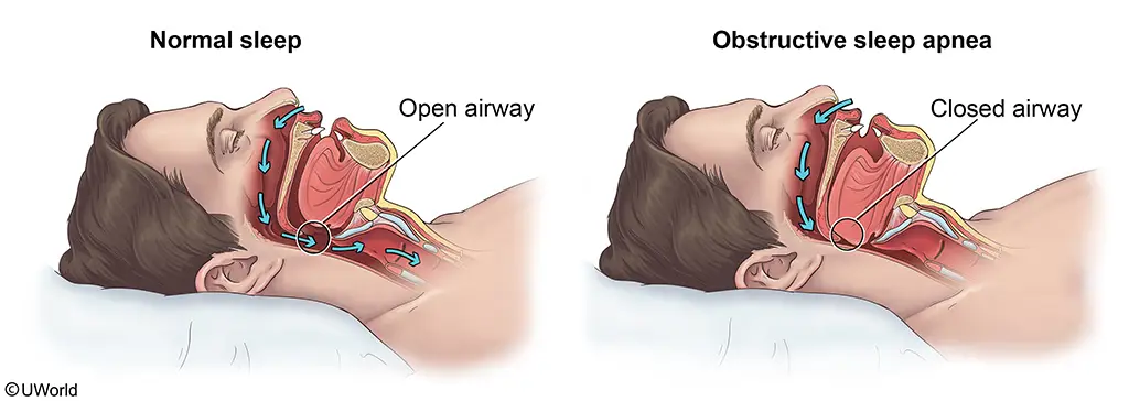 UWorld PA QBank practice question about obstructive sleep apnia.