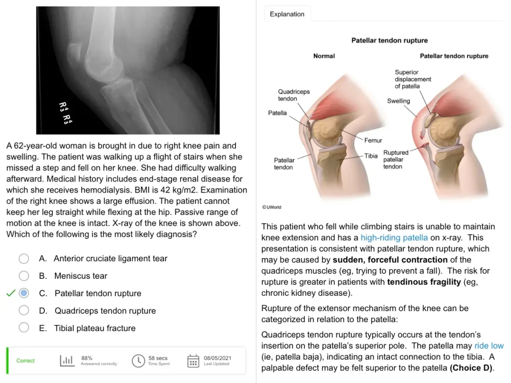 UWorld PANRE question depicting a patellar tendon rupture