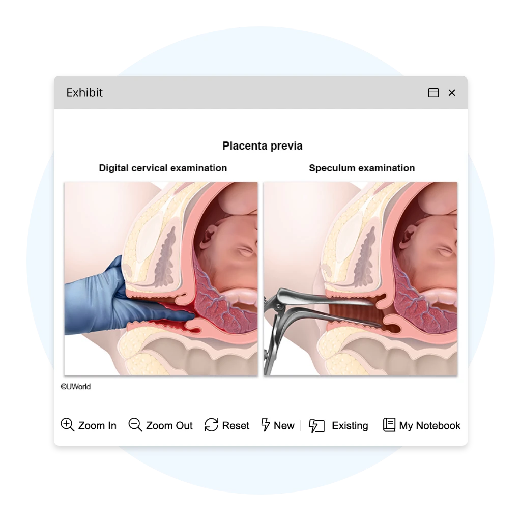 UWorld PA question about placenta previa